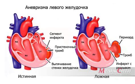 Аневризма и пульсация