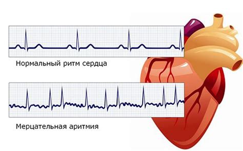 Аритмия: виды и распространенность