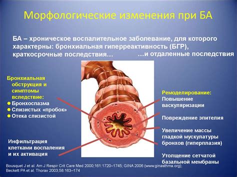 Бронхиальная астма: механизмы и воздействие на бронхи