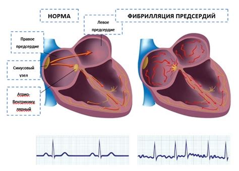 Бурение сердца и трепет в животе