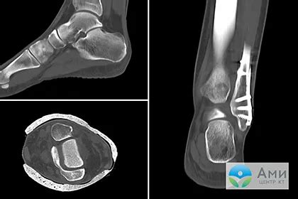 Важность КТ голеностопного сустава для взрослых