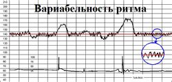 Важность расчета токо на КТГ