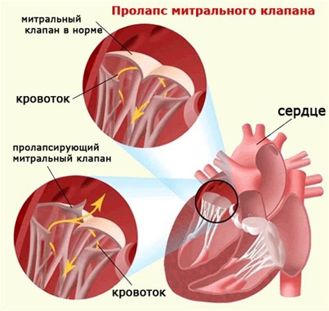 Важные факты о пролапсе митрального клапана, которые необходимо знать