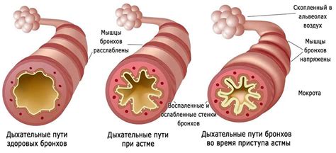 Виды астмы: отличия, симптомы и влияние на бронхи