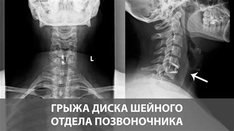 Виды операций при грыже в шейном отделе