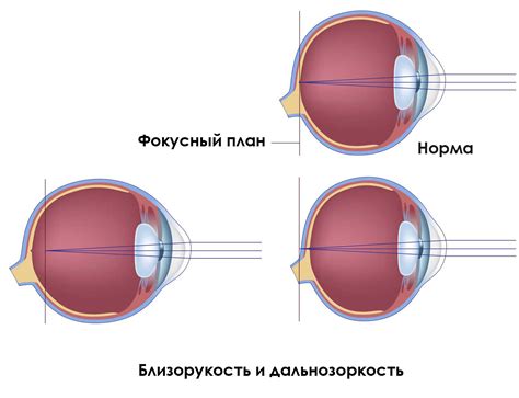 Виды потери зрения