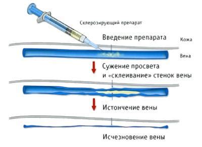 Виды растворов для компрессионной склеротерапии