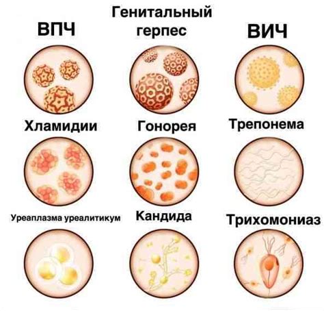 Вирусные инфекции, передающиеся половым путем