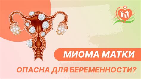 Влияние миомы на организм