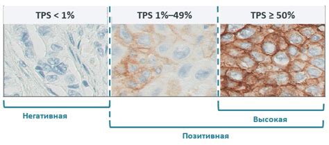 Влияние низкого уровня экспрессии гена PDL1 на иммунный ответ