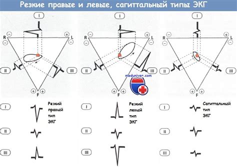 Влияние образа жизни на С-тип ЭКГ