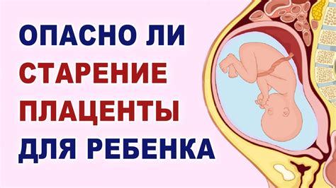 Влияние расположения плаценты на беременность