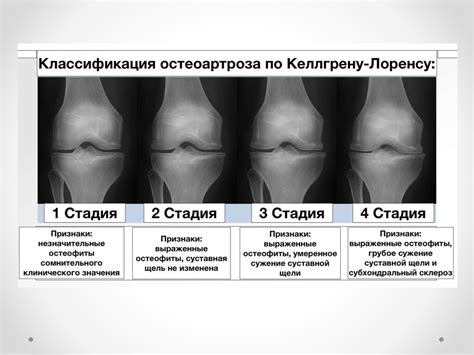 Возможность развития артроза