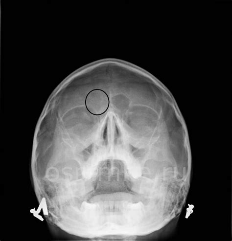 Возможные диагнозы при затемнении лобных пазух на рентгене
