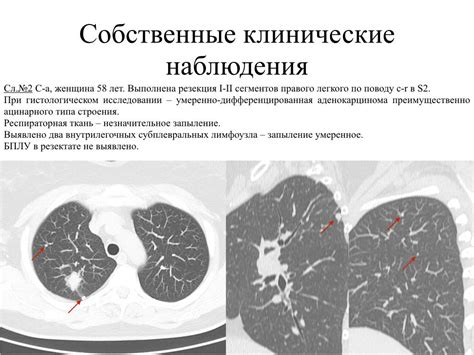 Возможные осложнения внутрилегочного лимфоузла на КТ