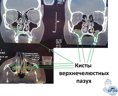 Возможные осложнения после операции по лечению дефекта медиальной стенки верхнечелюстной пазухи