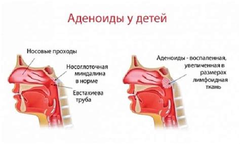 Возможные осложнения после удаления аденоидов