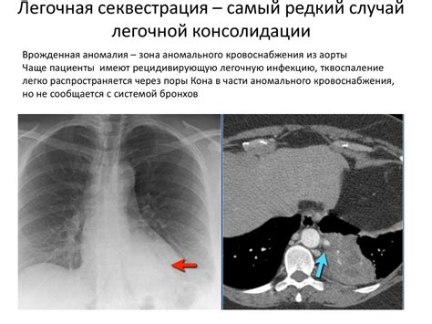 Возможные осложнения при консолидации легочной ткани