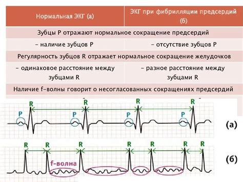 Возможные причины р острого в ЭКГ