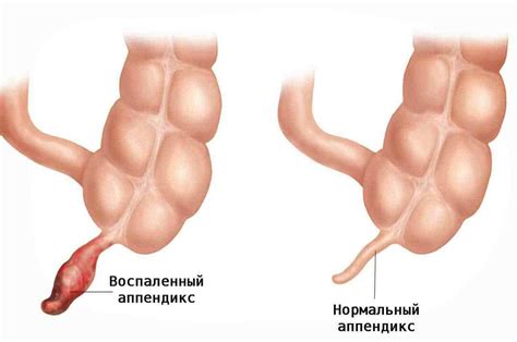 Воспаление аппендикса