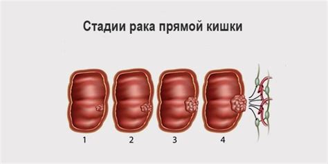 Воспалительные заболевания прямой кишки