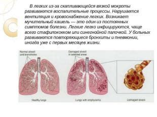 Воспалительные процессы в легких