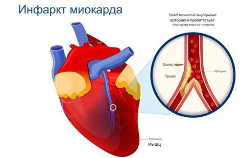 Временная функциональная нестабильность миокарда: признаки