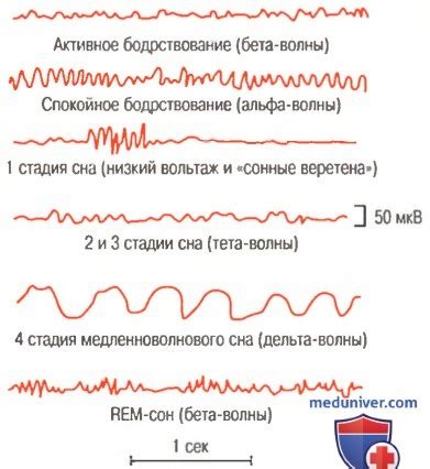 Вспышки тета волн на ЭЭГ: причины и последствия