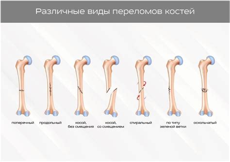 Выявление переломов и повреждений костей