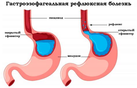 Гастроэзофагеальный рефлюкс