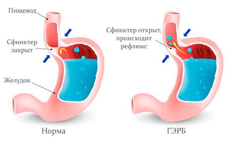 Гастроэзофагеальный рефлюкс: симптомы и лечение