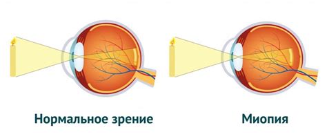 Генетические причины ухудшения зрения у взрослых