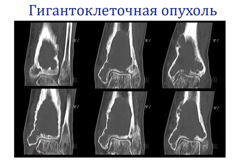 Гигантская клеточная опухоль: симптомы и причины