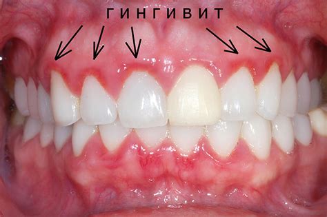 Гингивит и пародонтит