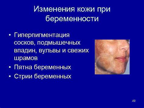 Гиперпигментация при беременности