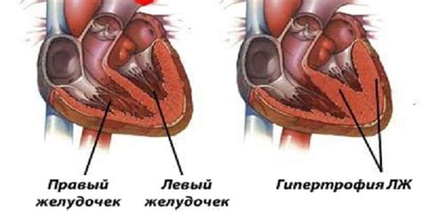 Гипертрофия передней стенки правого желудочка