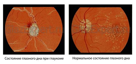 Глаукома глазного дна