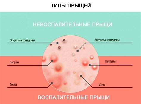 Гнойный прыщ: как заживлению помочь