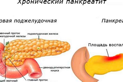 Головка поджелудочной железы