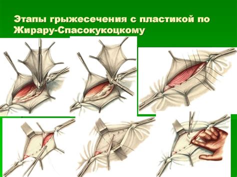 Грыжа пахового канала как возможная причина опухоли