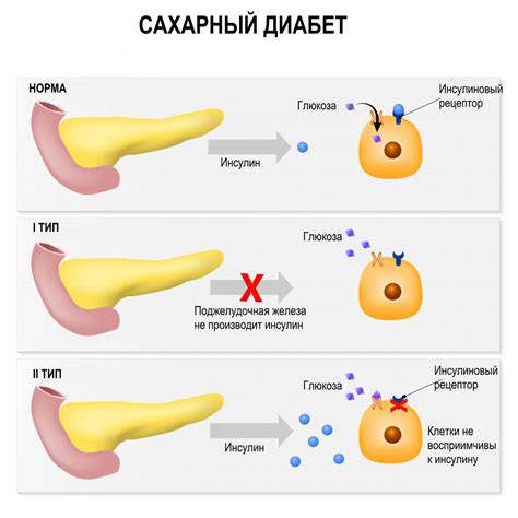 Диабет и его причины