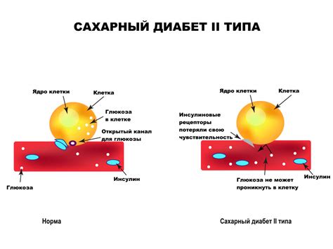 Диабет типа 2: причины и способы лечения