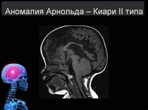 Диагностика аномалии Арнольда-Киари 2 степени