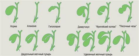 Диагностика аномалии желчного пузыря у ребенка