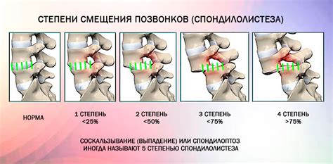 Диагностика антелистеза тела С4 позвонка