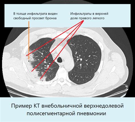 Диагностика бифуркационного лимфоузла в легких