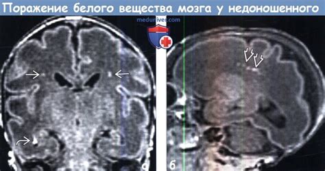 Диагностика воспаления белого вещества