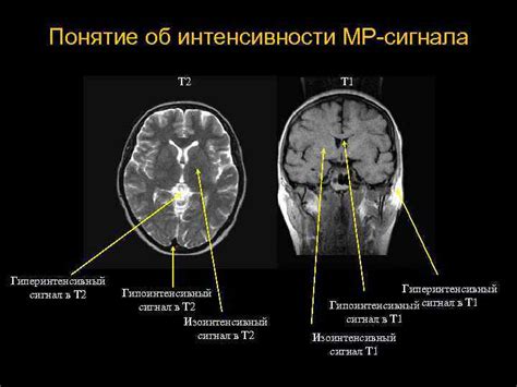 Диагностика гиперинтенсивных сигналов на Т2