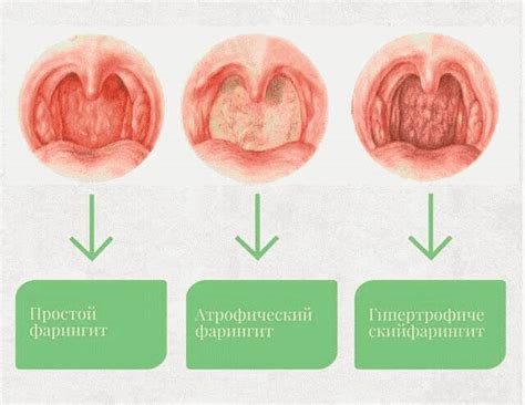 Диагностика гноя на задней стенке горла