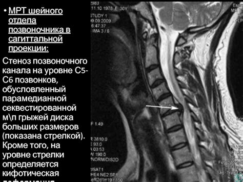 Диагностика грыжи в шейном отделе